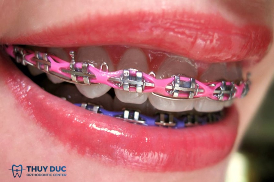 Đeo thun chuỗi có đau hay khó chịu không? 1