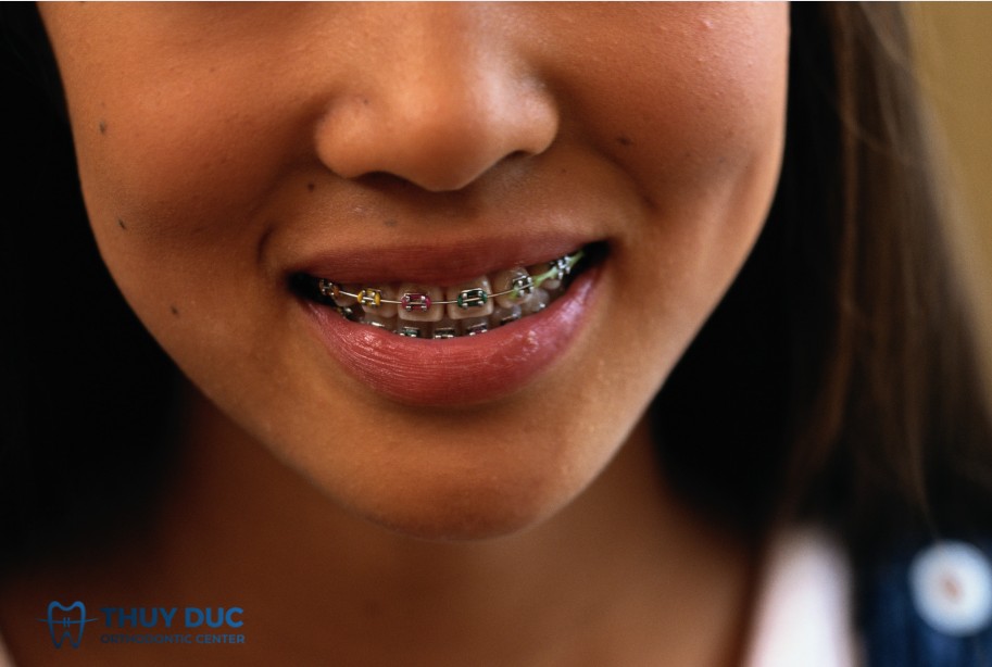 2. Giai đoạn sắp xếp răng 1 2. Giai đoạn sắp xếp răng 1