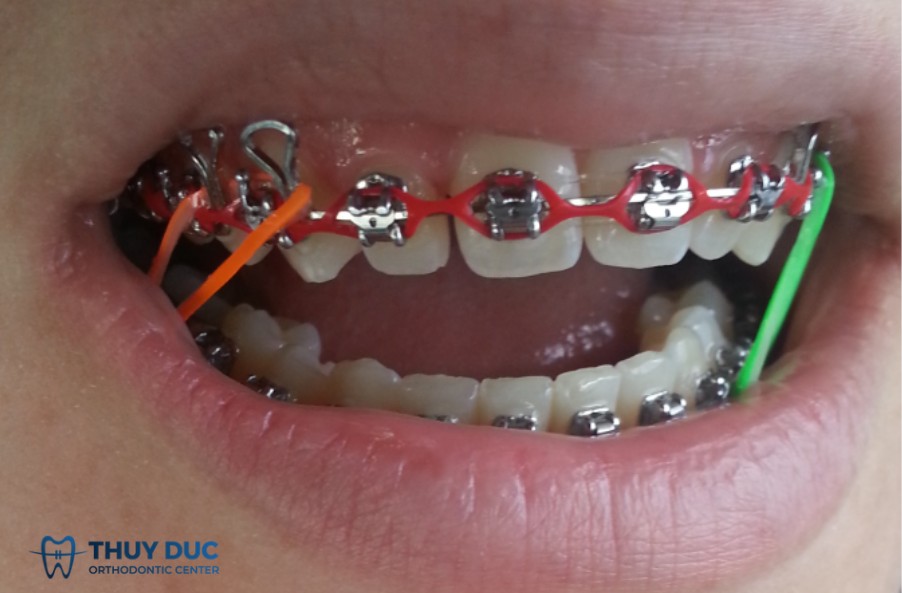 Các giai đoạn cần sử dụng thun chuỗi 1