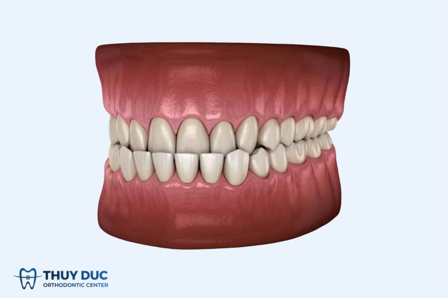 1. Răng móm là gì? 2 1. Răng móm là gì? 2