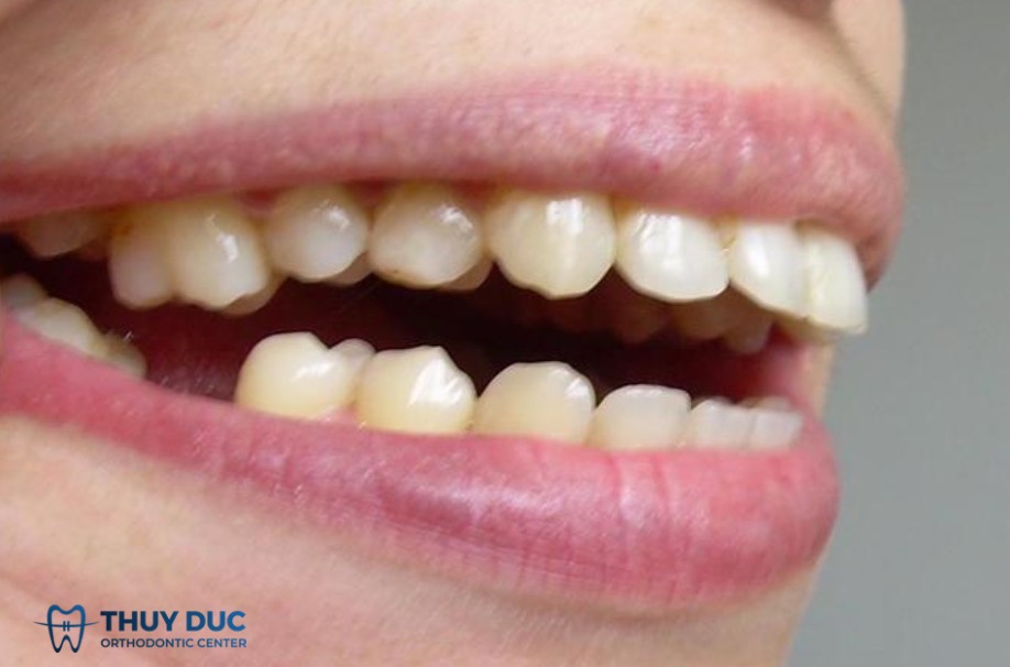 2. Nhận biết dấu hiệu răng hô 1