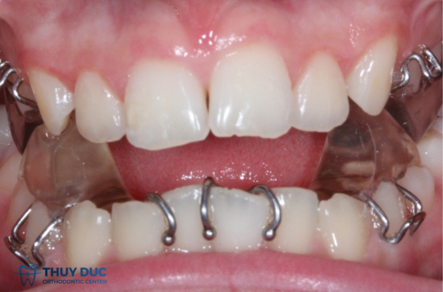 3. Khí cụ chức năng (Functional appliances) 1