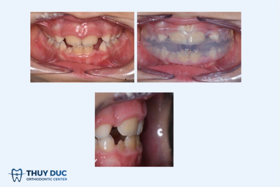 5. Hướng dẫn răng chưa mọc (Pre-eruption guidance) 1