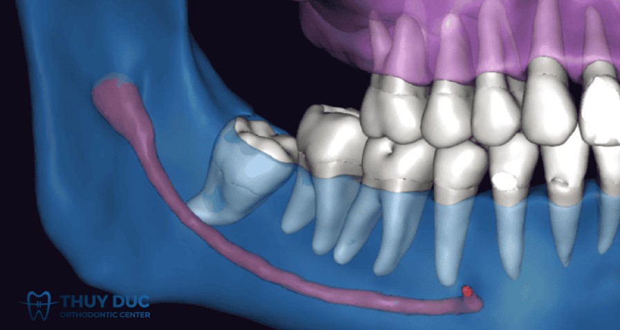 Tổn thương dây thần kinh 1 Tổn thương dây thần kinh 1