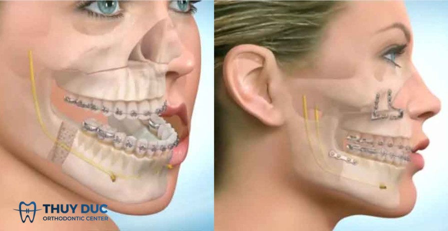 2. Niềng răng móm là gì? Niềng răng có hết móm không? 2 2. Niềng răng móm là gì? Niềng răng có hết móm không? 2