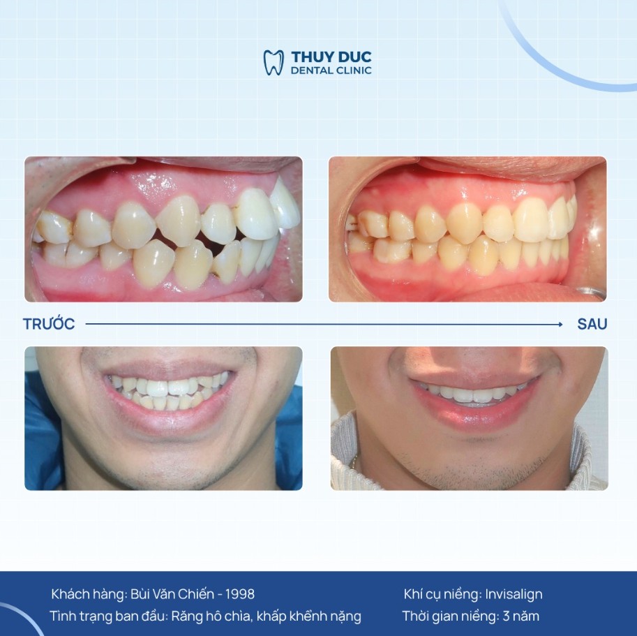 2. Người có răng chen chúc, khấp khểnh 1 2. Người có răng chen chúc, khấp khểnh 1