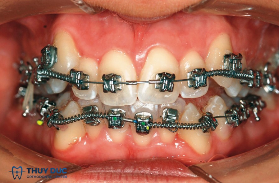 1. Giai đoạn đầu: Lắp mắc cài 1 1. Giai đoạn đầu: Lắp mắc cài 1