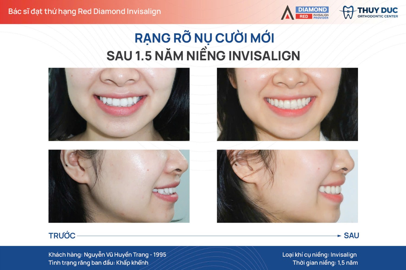 Hiểu lầm 2: Niềng răng làm mũi cao hơn 1 Hiểu lầm 2: Niềng răng làm mũi cao hơn 1