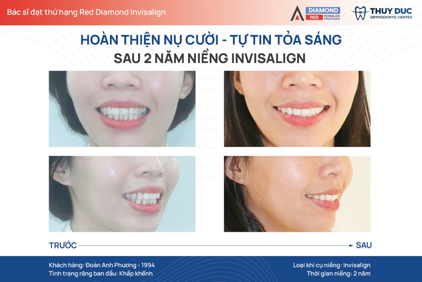 1. Niềng răng có làm thay đổi gương mặt không? 1 1. Niềng răng có làm thay đổi gương mặt không? 1