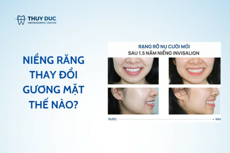 Niềng răng có làm thay đổi khuôn mặt? Các hiểu lầm phổ biến