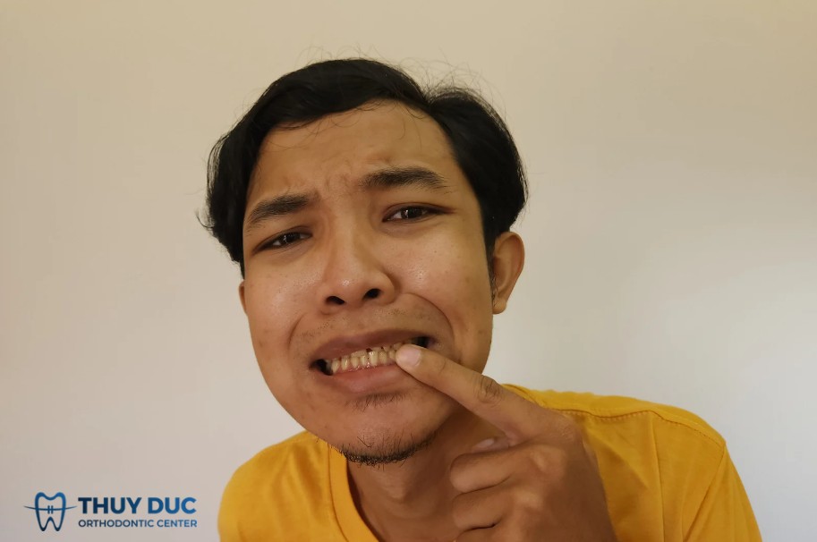 Vì sao răng ố vàng lâu năm khó làm trắng hơn? 1 Vì sao răng ố vàng lâu năm khó làm trắng hơn? 1