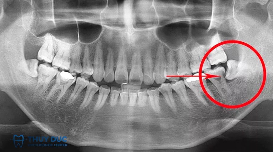 Ảnh hưởng lâu dài tới răng kế cận, chức năng hàm & xương 1 Ảnh hưởng lâu dài tới răng kế cận, chức năng hàm & xương 1