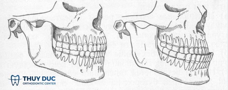 1. Răng móm là gì? 1 1. Răng móm là gì? 1