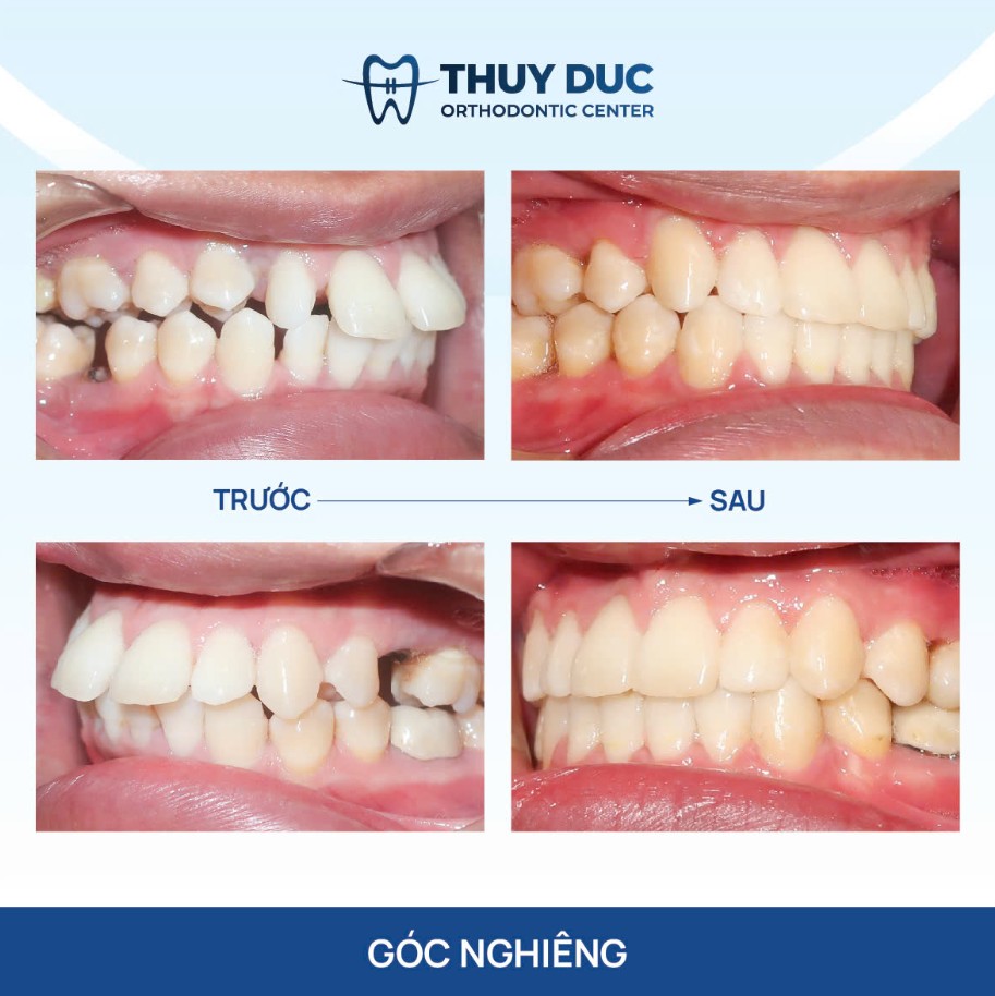 3. Thời gian niềng răng thưa trung bình 1