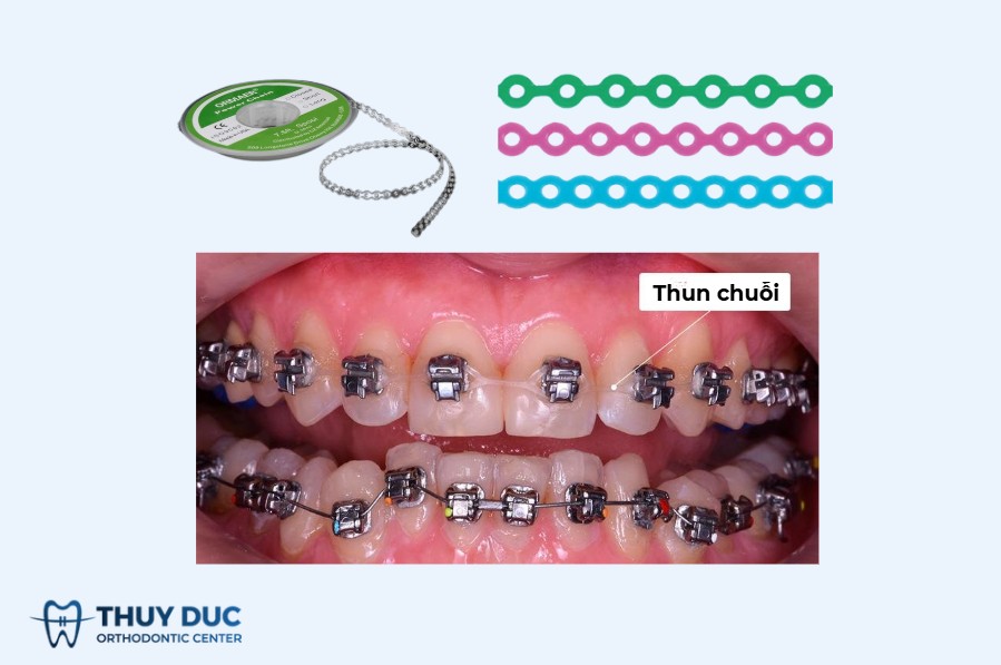 Thun chuỗi là gì? 1