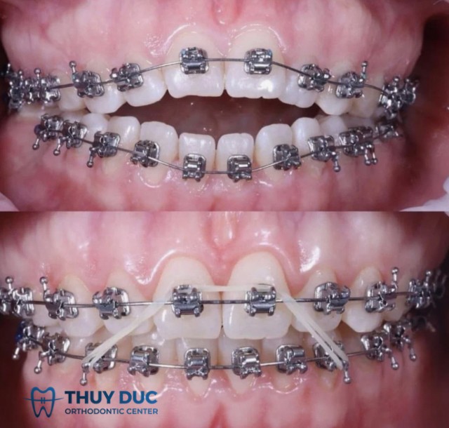 1. Lựa chọn loại mắc cài phù hợp (kim loại, sứ, trong suốt...) 1 1. Lựa chọn loại mắc cài phù hợp (kim loại, sứ, trong suốt...) 1