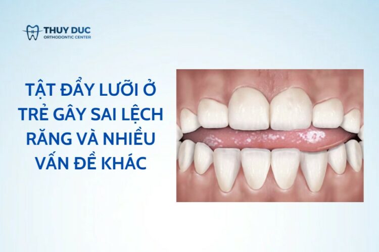 Tật đẩy lưỡi ở trẻ gây sai lệch răng và nhiều vấn đề khác