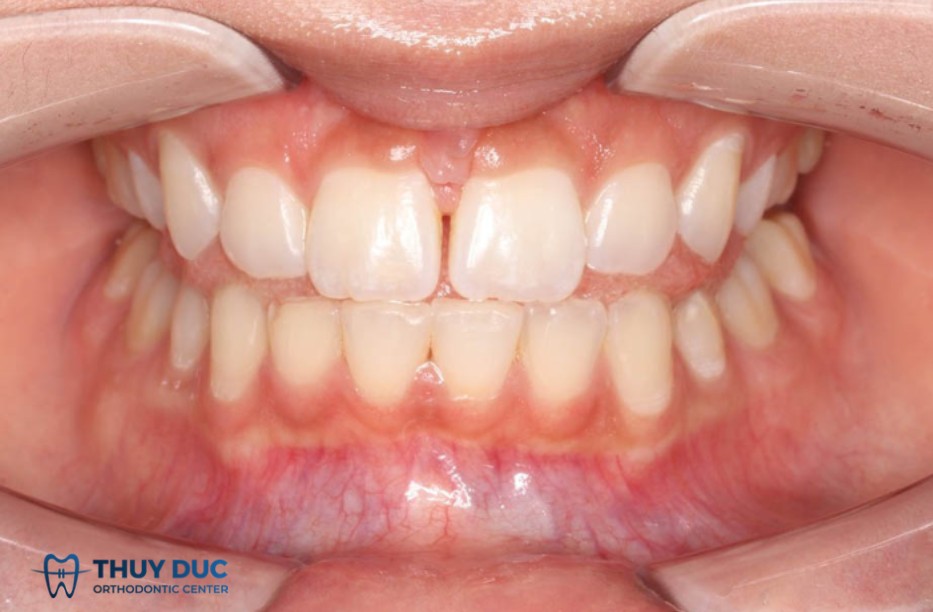 1. Liệu pháp chức năng cơ miệng 1