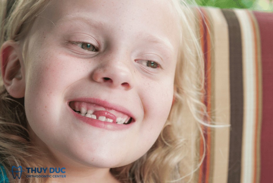 3. Dấu hiệu nhận biết tật đẩy lưỡi 1