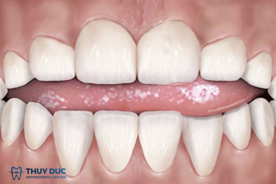 1. Tật đẩy lưỡi là gì? 1