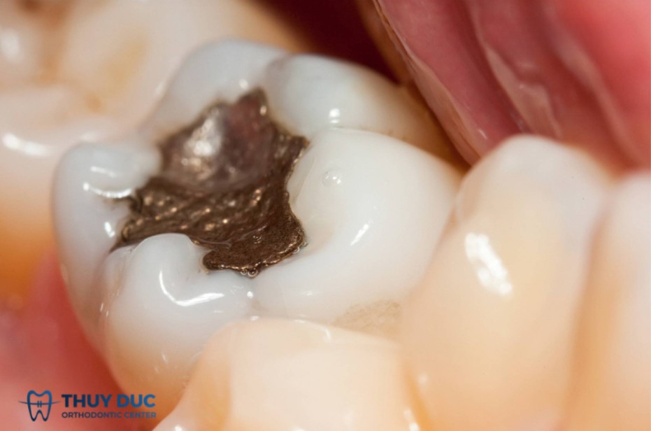 Các vật liệu trám răng hiện nay gồm có những loại nào 4