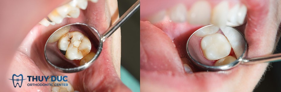 Các vật liệu trám răng hiện nay gồm có những loại nào 1