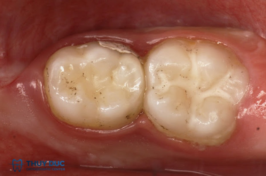 Những trường hợp nào nên trám răng bằng GIC? 1