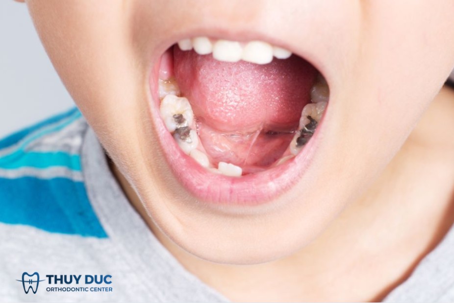 Trám răng cho trẻ em loại nào phù hợp? 1