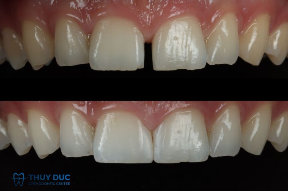 1. So sánh về hiệu quả thẩm mỹ 1