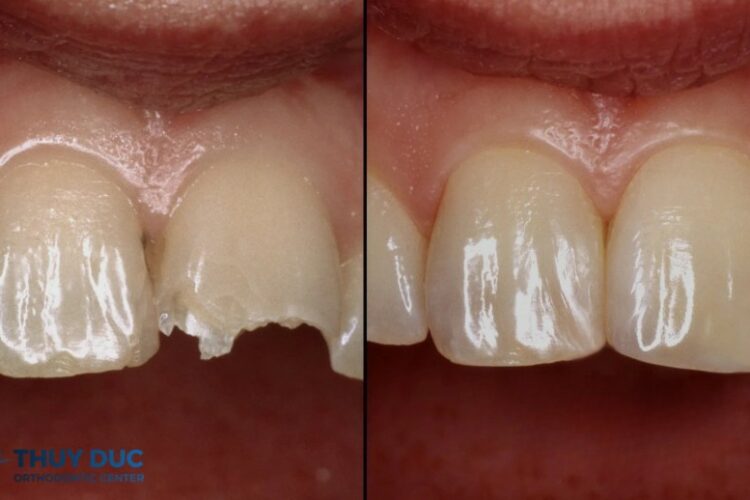 Trám composite thẩm mỹ khác gì trám thường?