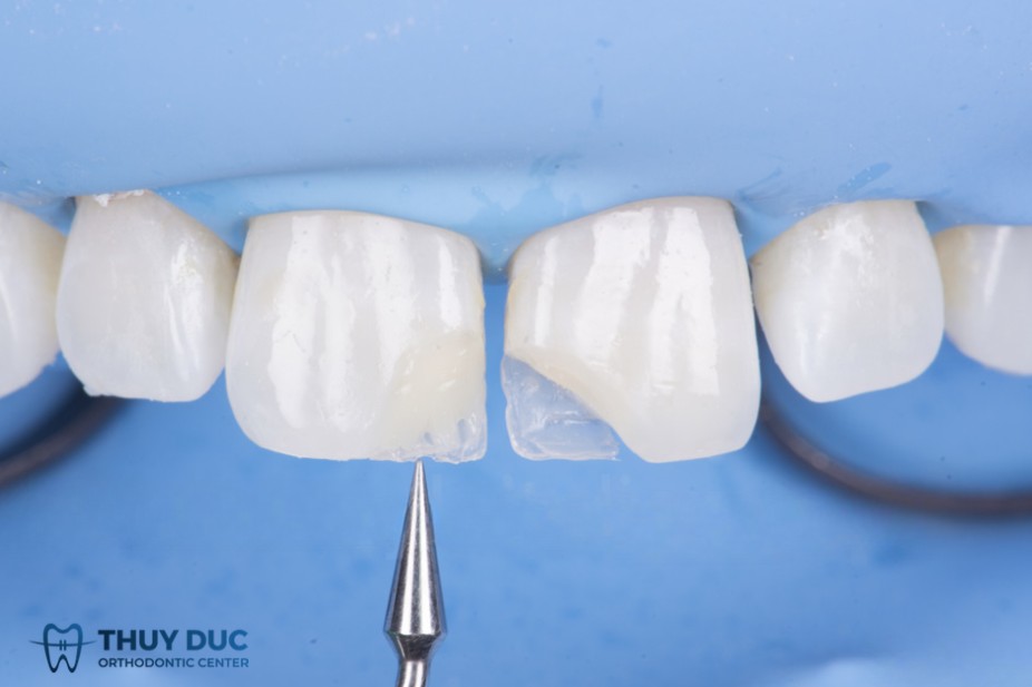 Trám composite là gì? 1