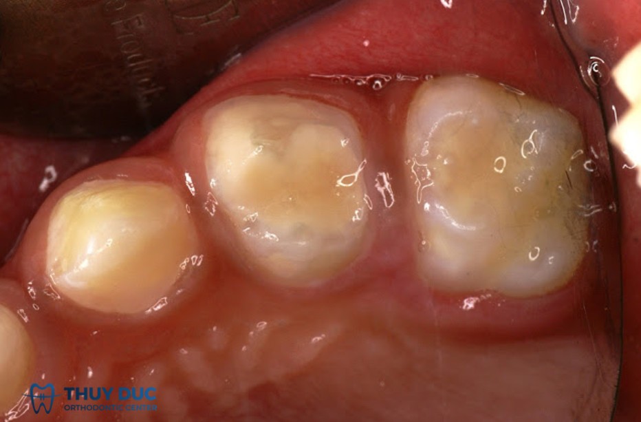 Trám răng bằng GIC có những ưu điểm nổi bật nào? 1