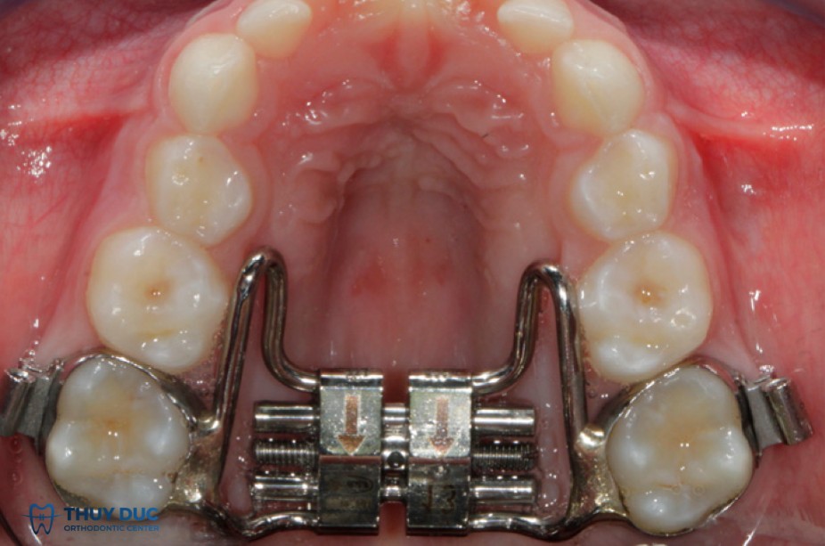 1. Nong hàm trong chỉnh nha là gì? 1