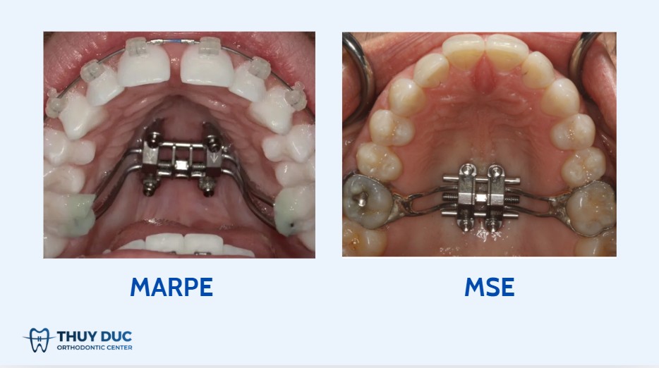 4.4. Khí cụ nong hàm có hỗ trợ mini vít (MARPE / MSE) 1