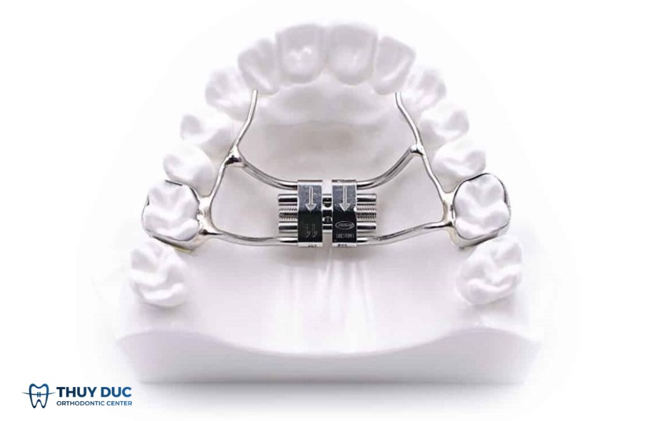 4.1. Khí cụ nong nhanh xương hàm (RPE – Hyrax – Haas) 2