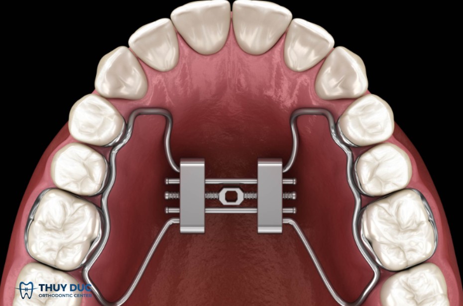 4.1. Khí cụ nong nhanh xương hàm (RPE – Hyrax – Haas) 1