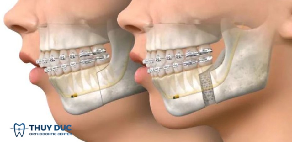 Phẫu thuật hàm dưới 1 Phẫu thuật hàm dưới 1