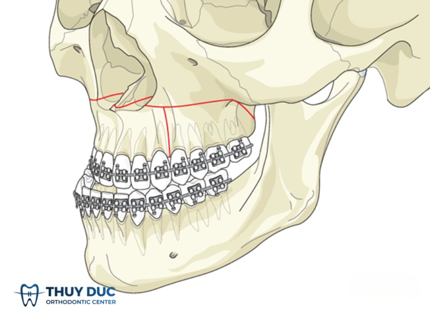 5. Mối quan hệ bắt buộc giữa phẫu thuật và niềng răng 1 5. Mối quan hệ bắt buộc giữa phẫu thuật và niềng răng 1