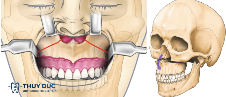 Phẫu thuật hàm trên 1 Phẫu thuật hàm trên 1