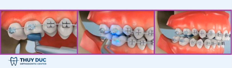 1. Nâng khớp cắn trong niềng răng là gì? 1 1. Nâng khớp cắn trong niềng răng là gì? 1