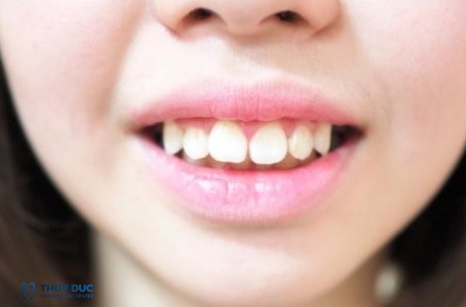 2. Riêng về phụ nữ có răng cửa to 1