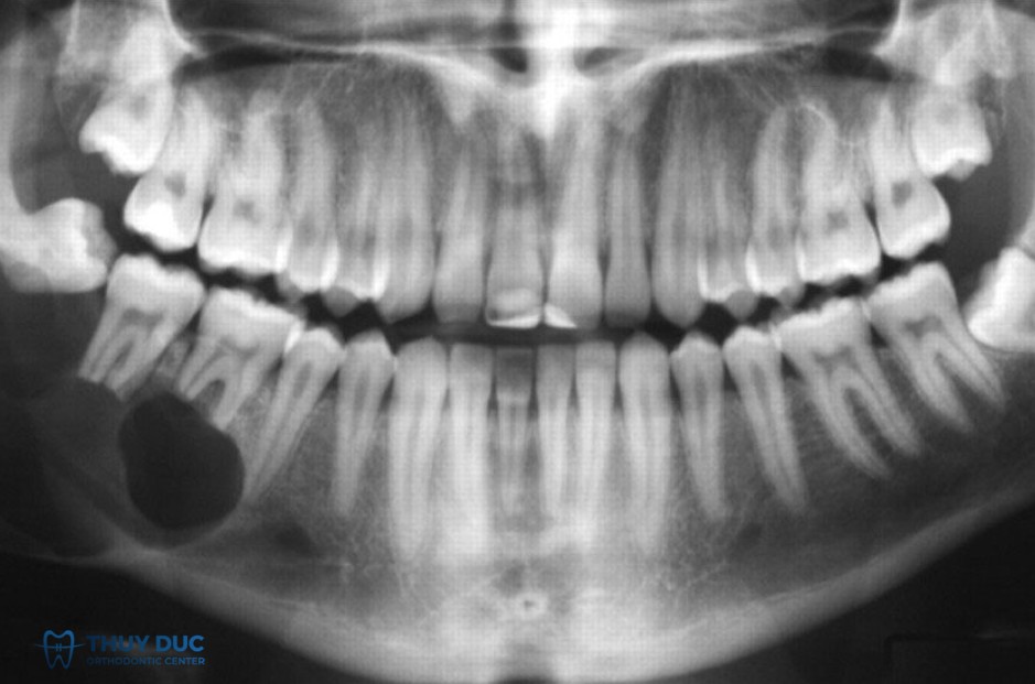 Nguyên nhân hình thành chân răng dùi trống 1 Nguyên nhân hình thành chân răng dùi trống 1