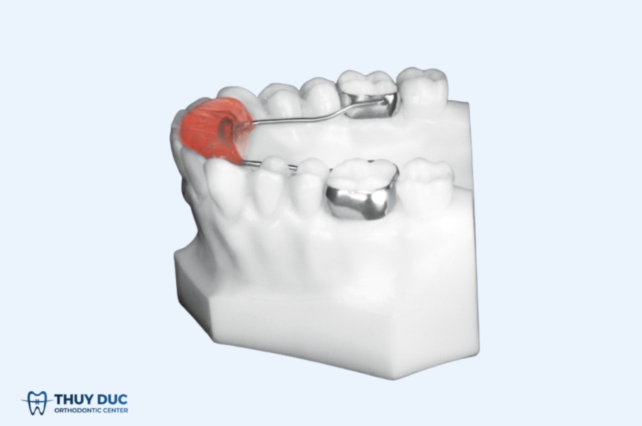 4.2. Nâng khớp cắn bằng khí cụ chỉnh nha 1 4.2. Nâng khớp cắn bằng khí cụ chỉnh nha 1