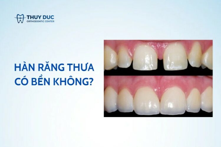Hàn răng thưa có bền không?