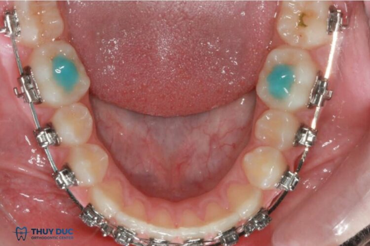 4.1. Nâng khớp cắn bằng composite 1 4.1. Nâng khớp cắn bằng composite 1