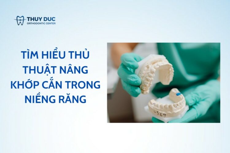 Kỹ thuật nâng khớp cắn trong niềng răng