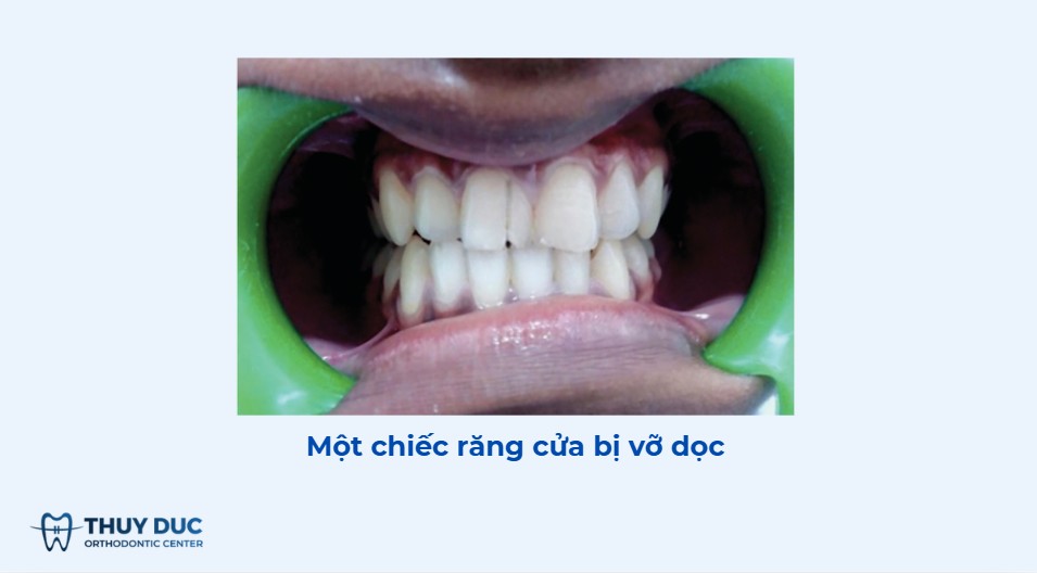 Trường hợp 2: Vỡ dọc ăn vào tủy nhưng chưa tách chân răng 1
