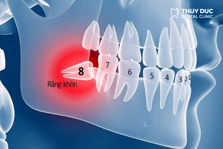 Khi nào cần nhổ răng khôn mọc lệch, mọc ngầm? 1