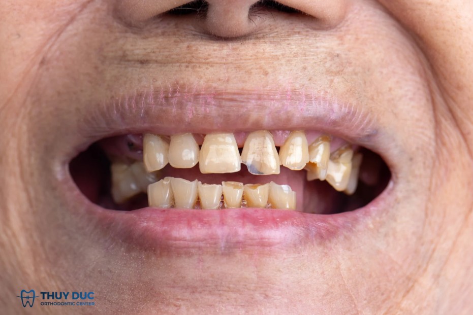 2. Biểu hiện lâm sàng của răng lão hóa 1