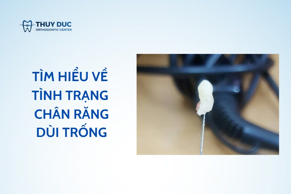 Chân răng dùi trống là gì và thường được phát hiện như thế nào? 1 Chân răng dùi trống là gì và thường được phát hiện như thế nào? 1